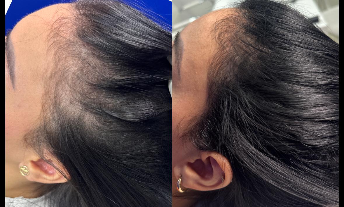 Antes do tratamento - Alopecia Areata