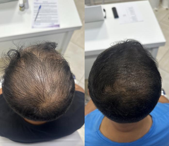 Antes do tratamento - Queda Capilar Intensa