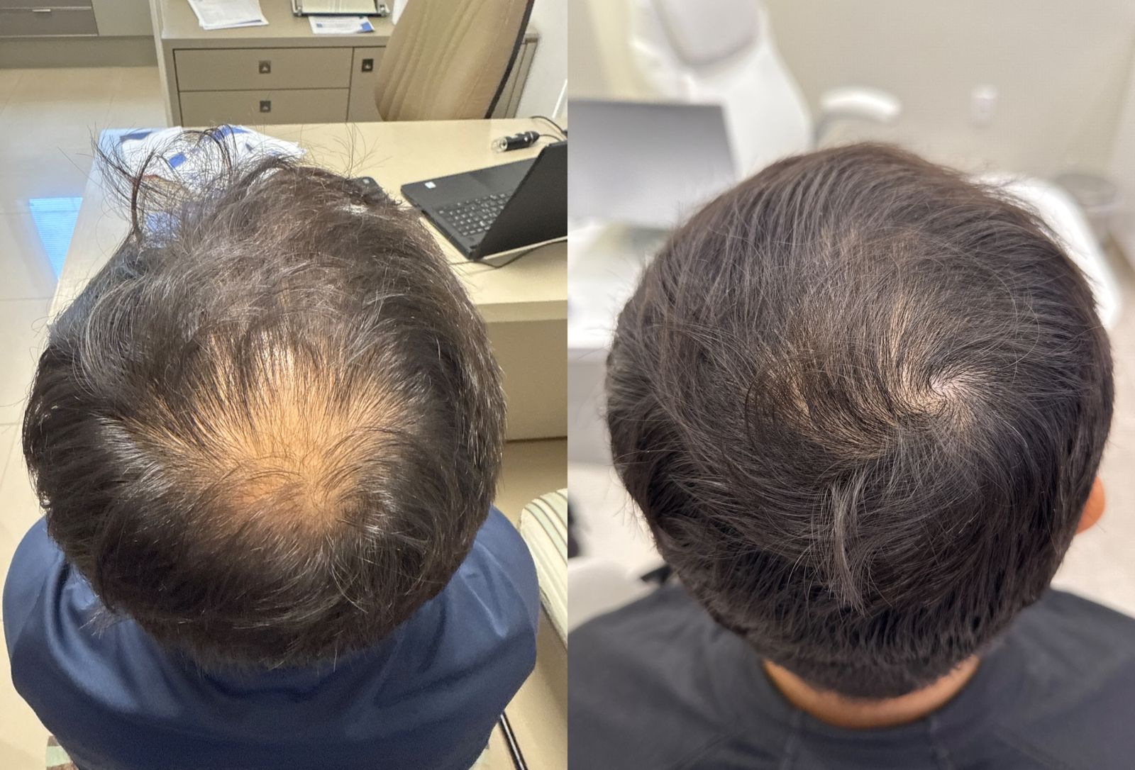 Antes do tratamento - Falhas no Cabelo