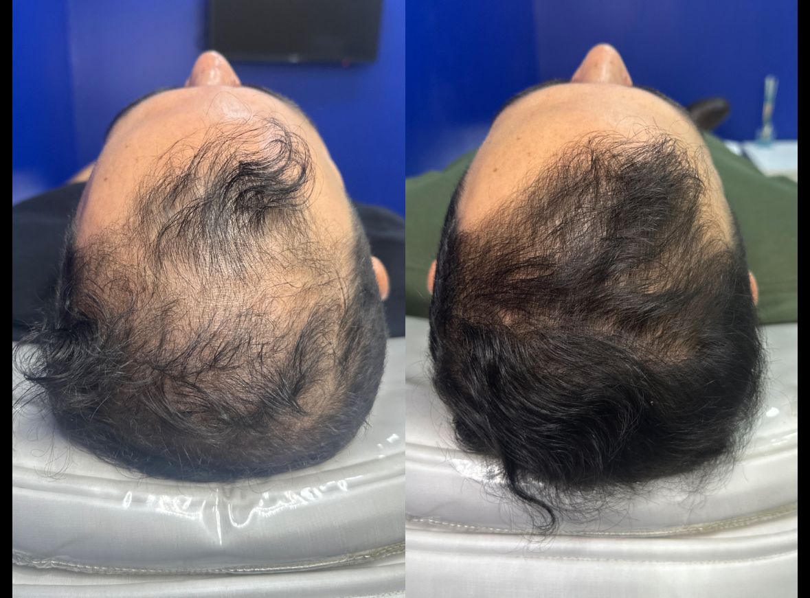 Antes do tratamento - Alopecia Androgenética